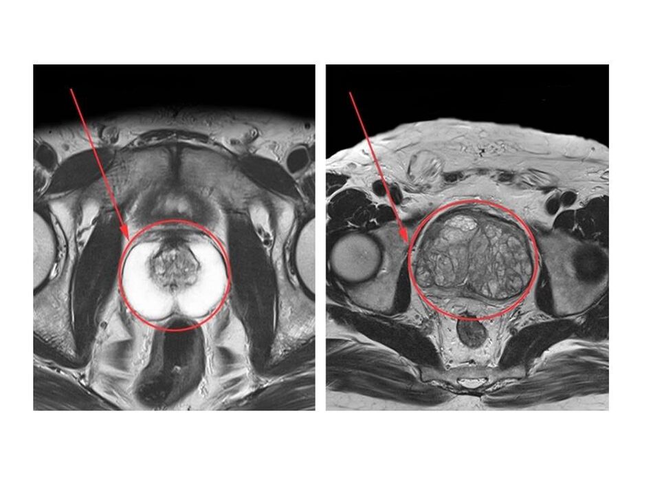Porównanie zdrowej (po lewej) i objętej stanem zapalnym (po prawej) prostaty na obrazach MRI